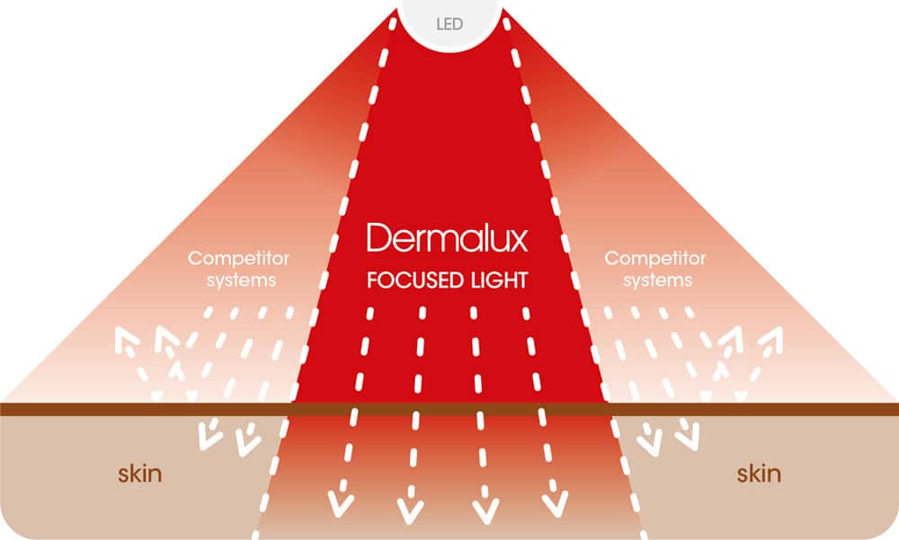 Dermalux' LED-technologie gerichte lichtbundel